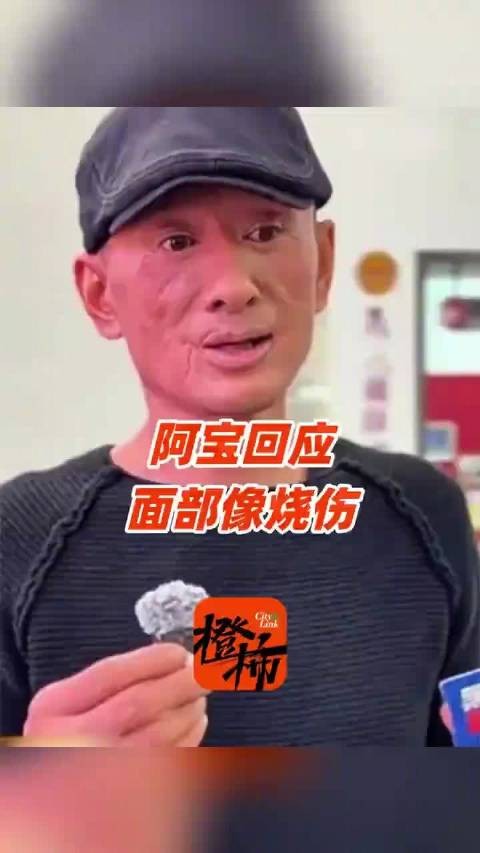 歌手阿宝回应面部疤痕似烧伤
